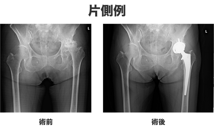 片側例